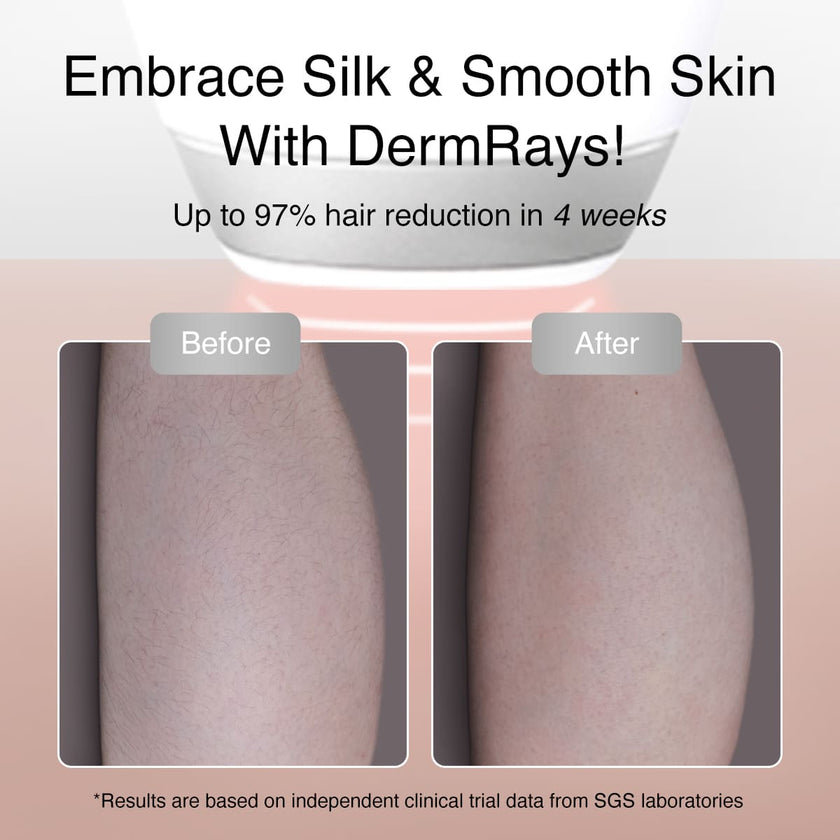 DermRays V4S Laser Hair Removal, Up to 21J, Specifically For Sensitive Skin